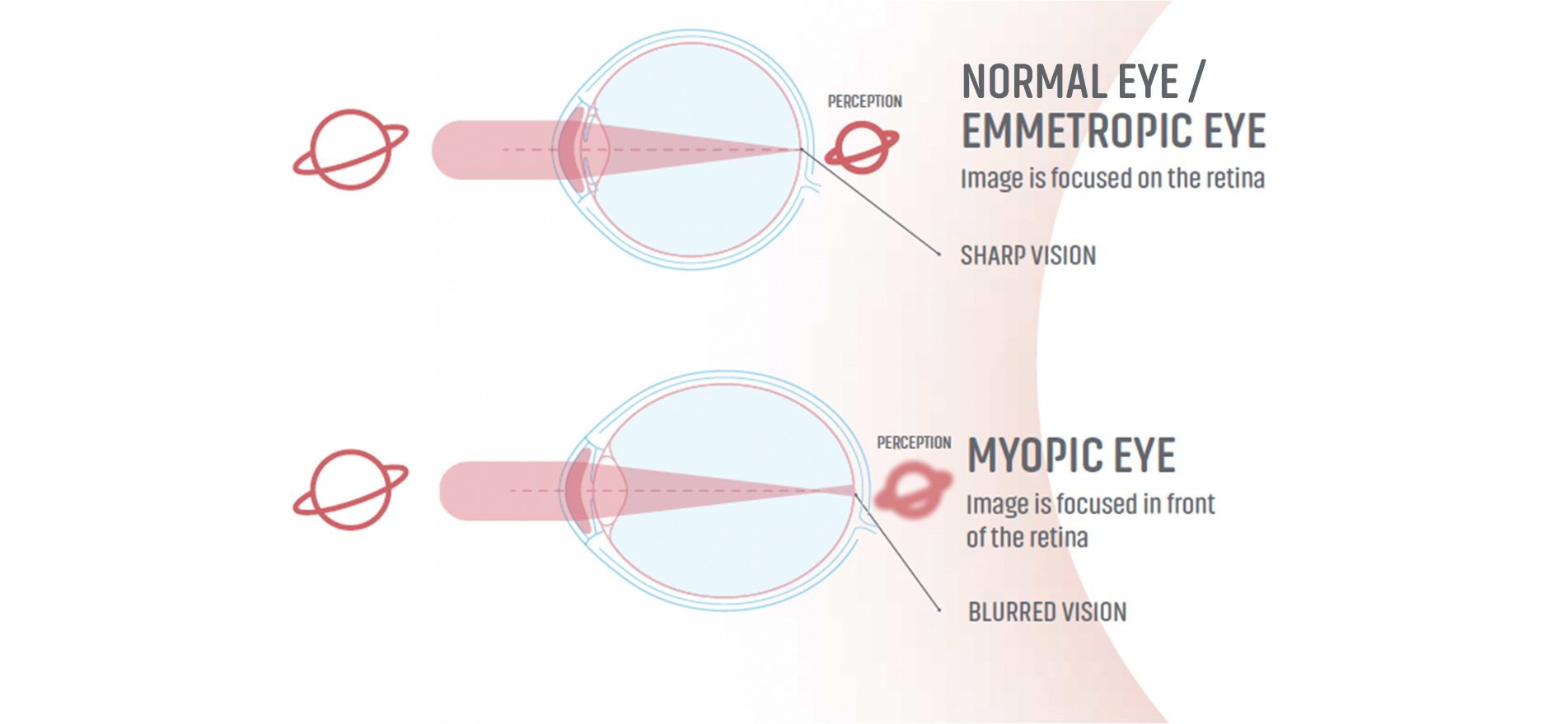 stellest myopia control lens myopic eyes